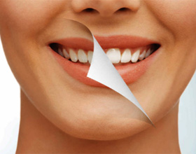 Отбеливание зубов: плюсы, минусы и особенности