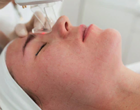 Лазерная шлифовка лица — плюсы и минусы процедуры