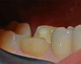Керамическая вкладка на зуб: плюсы и минусы