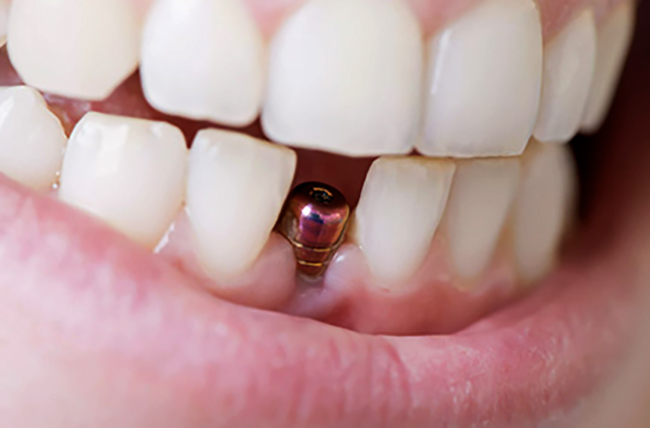 Проведение имплантации зубов