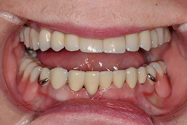 Бюгельные съемные зубные протезы во рту