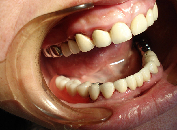 Использование бюгельных съемных зубных протезов