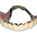 Бюгельные съемные зубные протезы: плюсы и минусы
