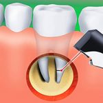 Резекция верхушки корня зуба — плюсы и минусы процедуры