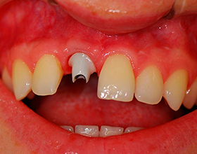 Стоит ли заменять мертвые передние зубы коронками?