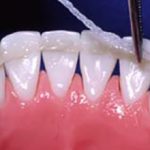 Шинирование зубов — плюсы и минусы метода