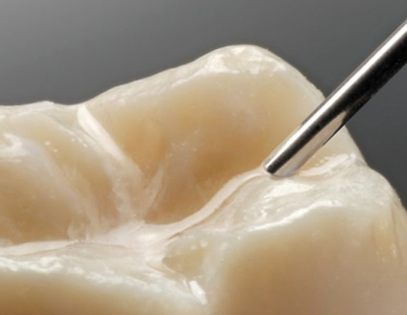 Нанесение герметика на зубы