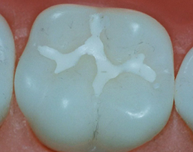 Герметик для зубов — плюсы и минусы использования