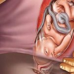 Если при родах порвалась шейка матки — возможные последствия