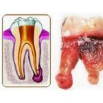 Киста зуба — причины и возможные последствия