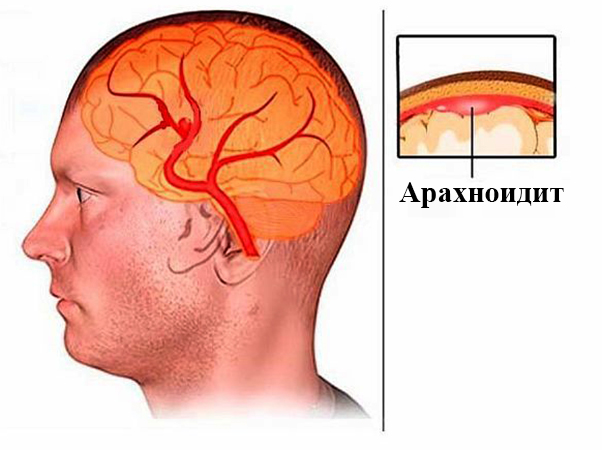 Арахноидит головного мозга
