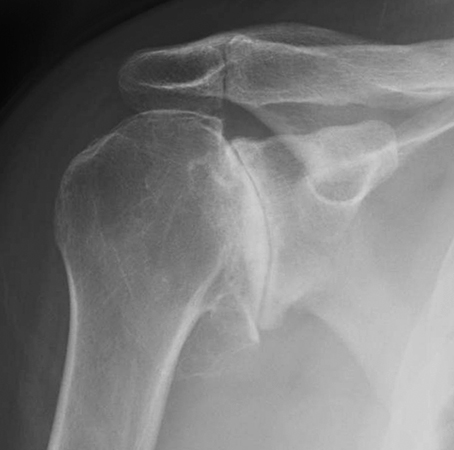 Рентген артрита плеча