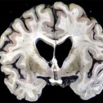 Отмирание коры головного мозга: причины и последствия