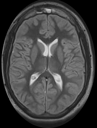 Снимок мозга с ишемией