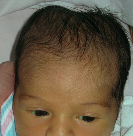Кефалогематома у новорожденных на голове