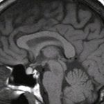 Микроаденома гипофиза головного мозга: причины и последствия