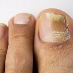 Возможные последствия грибка ногтей для организма