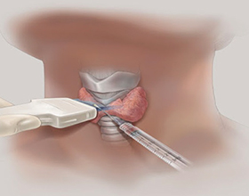Пункция щитовидной железы: влияние и последствия