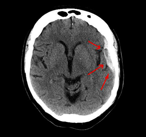 Субдуральная гематома головного мозга на снимке