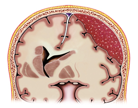 Субдуральная гематома головного мозга: что это, причины и последствия