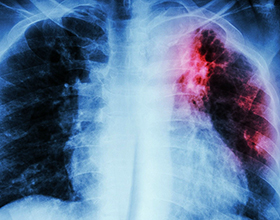 Причины и последствия туберкулеза для организма