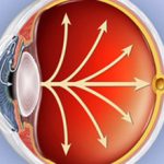 Высокое глазное давление, его причины и последствия