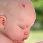 Сосудистая гемангиома у новорожденных: причины и последствия