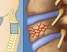 Последствия компрессионного перелома грудного отдела позвоночника