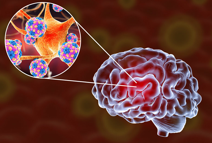 Последствия энцефалита для мозга