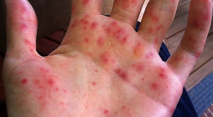 Проявление вируса на руке