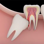 Последствия удаления зуба мудрости для человека