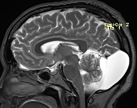 Ретроцеребеллярная киста головного мозга: что это, причины и последствия