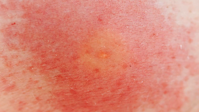 Аллергия после укуса осы