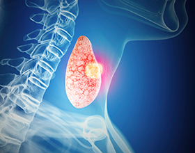 Рак щитовидной железы и его возможные последствия