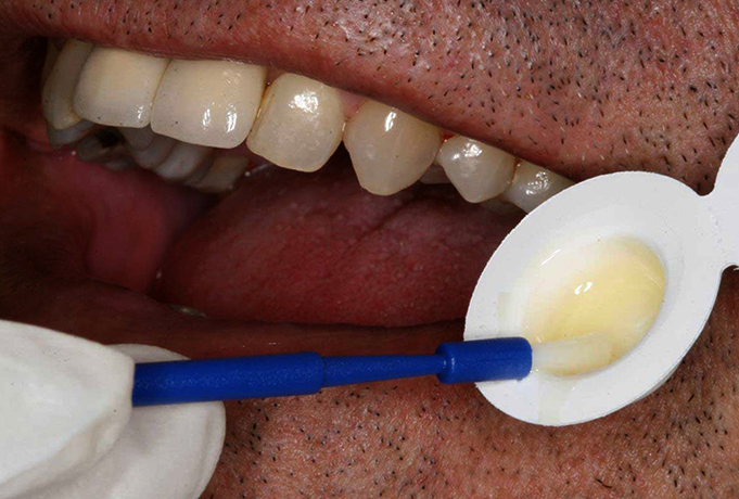 Фторирование зубов в клинике