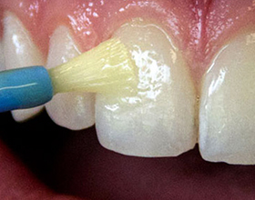 Фторирование зубов: плюсы и недостатки метода