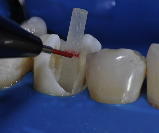 Использование стекловолокна в стоматологии