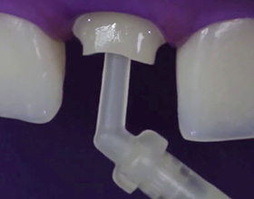 Стекловолокно в стоматологии: плюсы и минусы